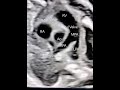 Fetal right ventricular outflow tract (RVOT) #drnupurshah #fetalechocardiography Mp3 Song
