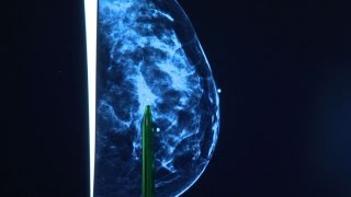 Scientists develop new classifications for breast cancer