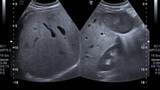 Multiple R Neoplasms - Focal Nodular Hyperplasia