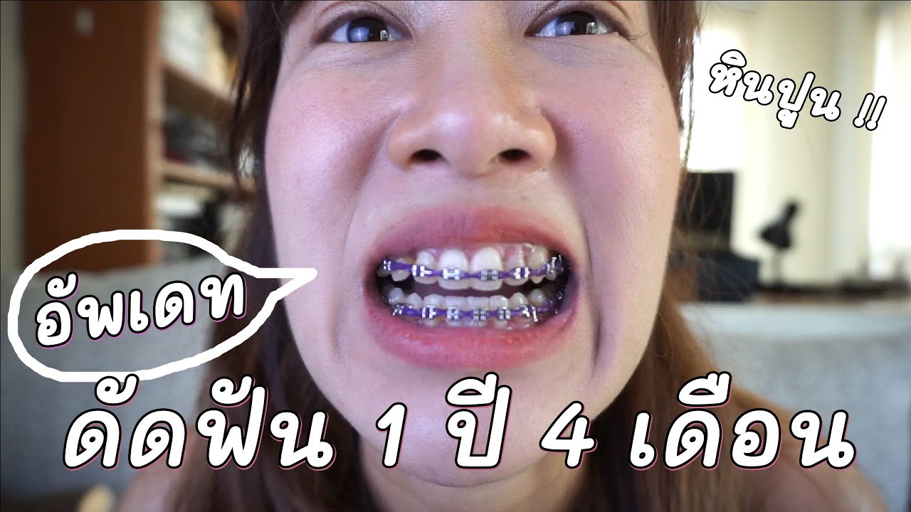 อัพเดท จัดฟันครบ 1 ปี 4 เดือน จู่ๆ ก็เจอหินปูนเต็มเลย | Archiiอาชิ - Youtube