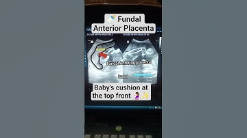 Fundal Anterior Placenta on Ultrasound 🍼 | Pregnancy Scan View #ultrasound #baby