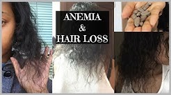 Deficiency Head On Thinning Hair Ny New York Sides Iron Of Female