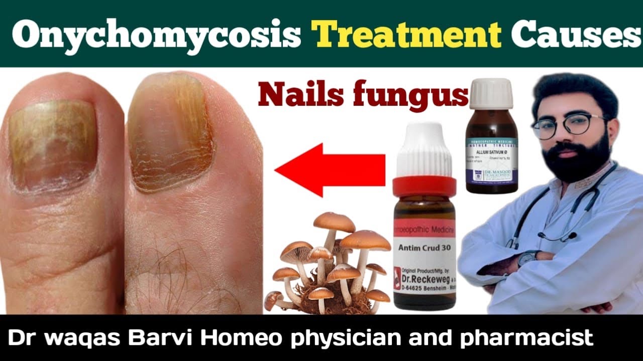 Nail fungus treatment at homenail fungus homeopathic treatmentonychomycosis treatment YouTube