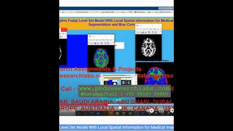 An Adaptive Fuzzy Level Set Model With Local Spatial Information for Medical Image Segmentation
