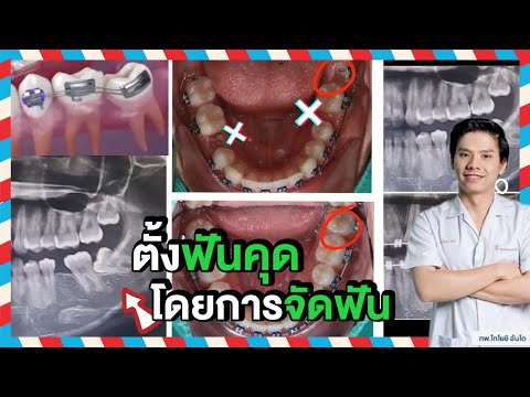 จัดฟันตั้งฟันคุด@softandsmiledentalclinic