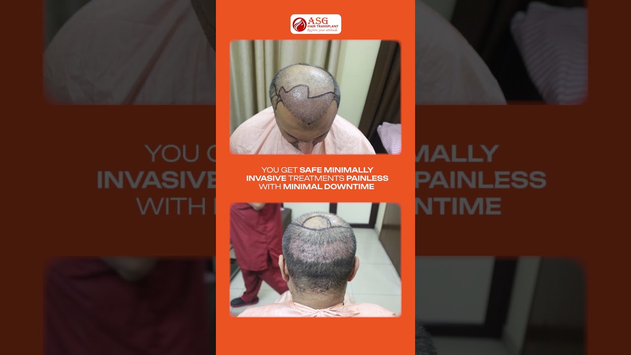Advanced FUE & Bio-FUE for Natural Growth: Hair Transplant in Ludhiana | ASG Hair Transplant
