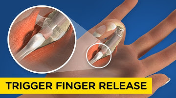 How Trigger Finger can happen to you (and how it