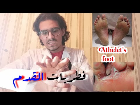 فطريات القدم - الأسباب, الأعراض, العلاج, الوقايةFoot Fungus - Causes, Symptoms,Treatment, Prevention