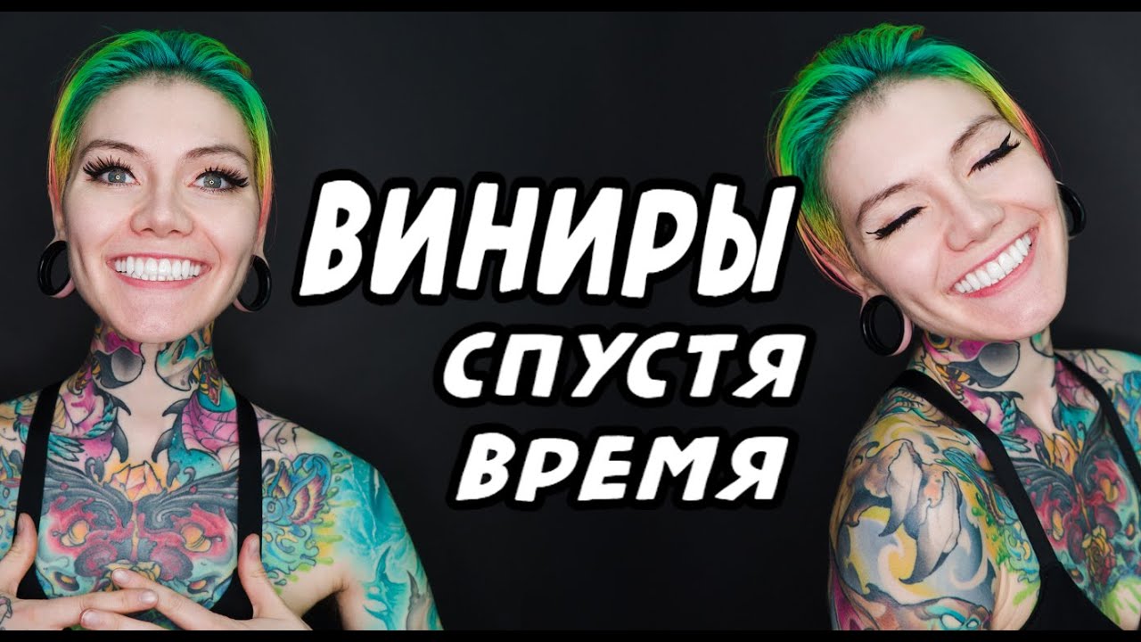 Виниры. Отзыв спустя время. Моя история
