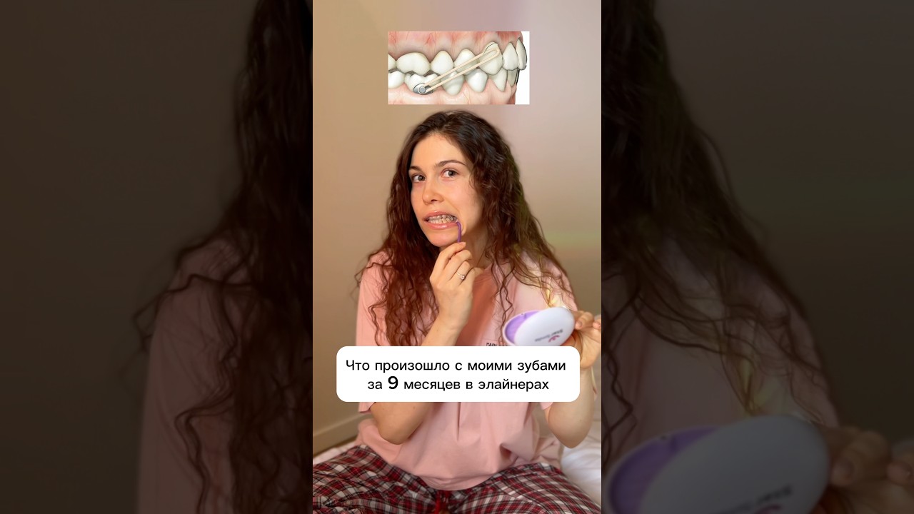 Что произошло с моими зубами за 9 месяцев в элайнерах🥶