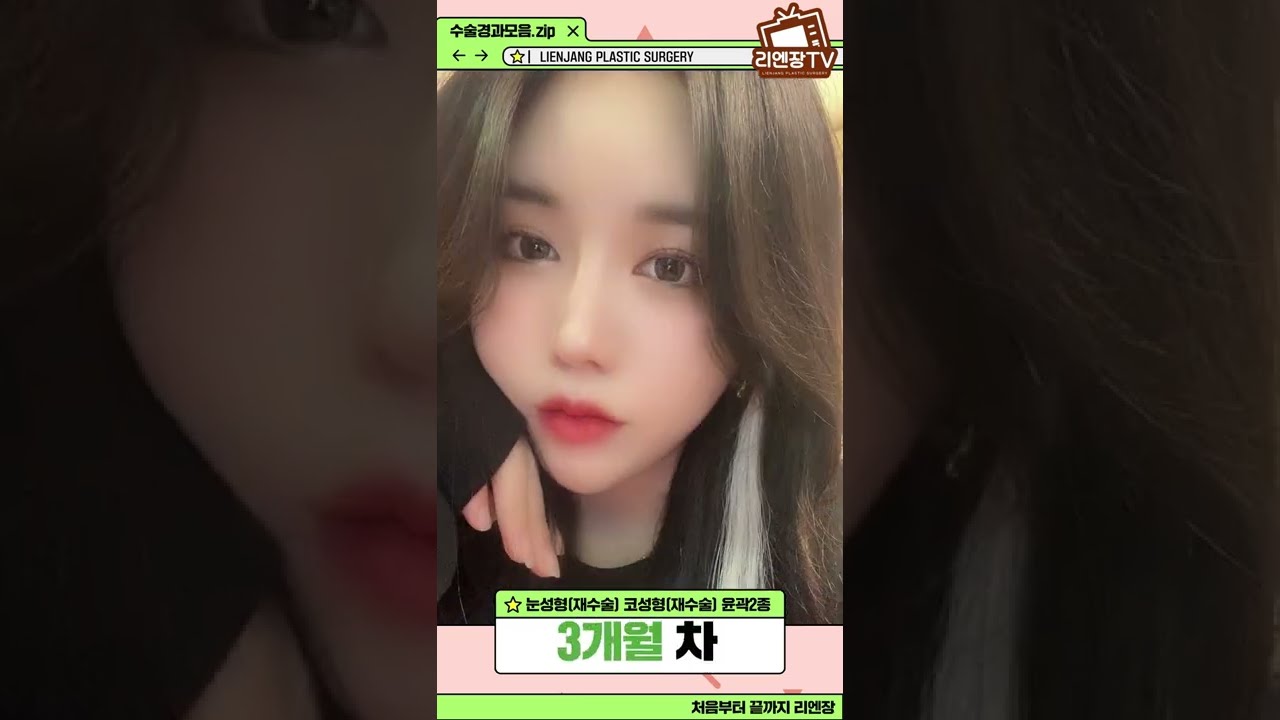 [Лиенжан гоо сайхны мэс заслын эмнэлэг] Нүдээ давтан мэс засал хийлгэж, хамраа өндөрлүүлж, нүүрний хэлбэр заслын хоёр төрлийн мэс засал хүртэл хийлгэсэн чинь... Инстаграм бурхан 💕