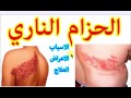 الحزام الناري اسبابه اعراضه وعلاجه .. موضوع شامل ومبسط