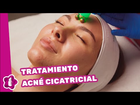Acné cicatricial: ¿Cuándo hacerse un tratamiento contra este tipo de acné?