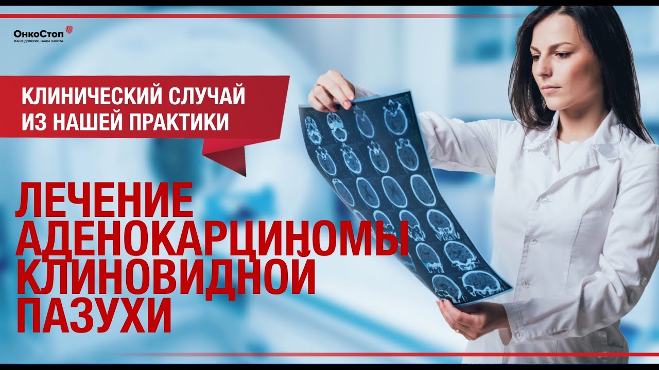 Аденокарцинома клиновидной пазухи. Как достигнуть регрессии?