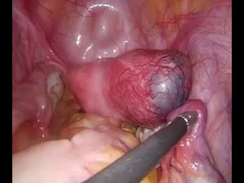 Cornual Ectopic Pregnancy