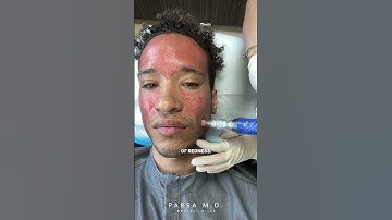 Microneedling with PRP for Acne Scars | Kami Parsa, M.D. #skincare #acnescars