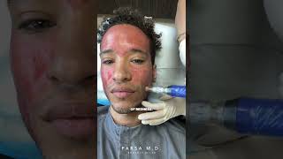 Microneedling with PRP for Acne Scars | Kami Parsa, M.D. #skincare #acnescars