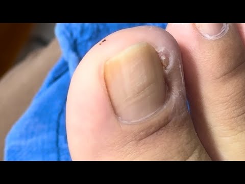 Ep_6482 Ingrown toenail removal 👣 หนูสงสัย..ทำไมไม่หายสักที 😄 (clip from Thailand)