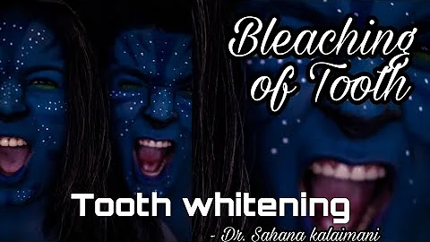 The Ultimate Guide to Tooth Whitening: Benefits, Mechanism, and Bleaching Agents