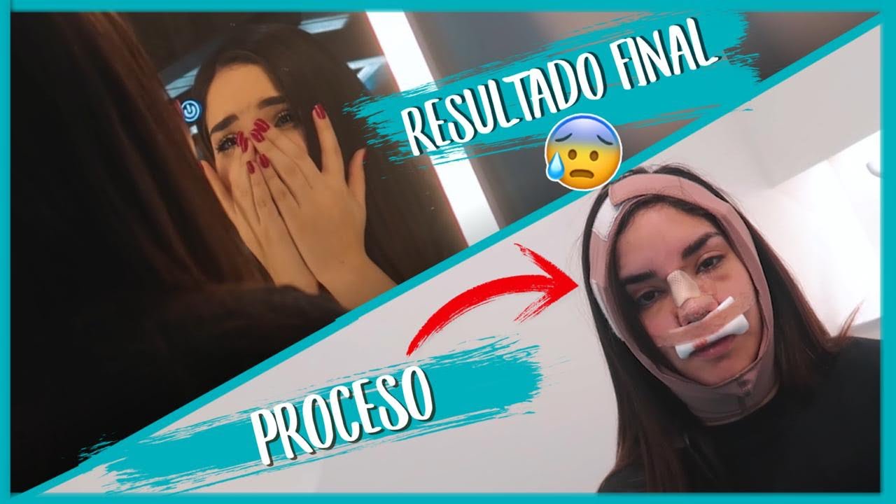 RESULTADO DE MI OPERACIÓN 🤕 (+ RECUPERACIÓN) Kimberly Loaiza