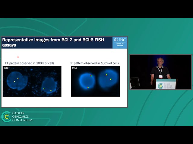 Detection of IGHMYC and a cryptic IGHBCL6 rearrangement refines diagnosis in high grade B-Cell