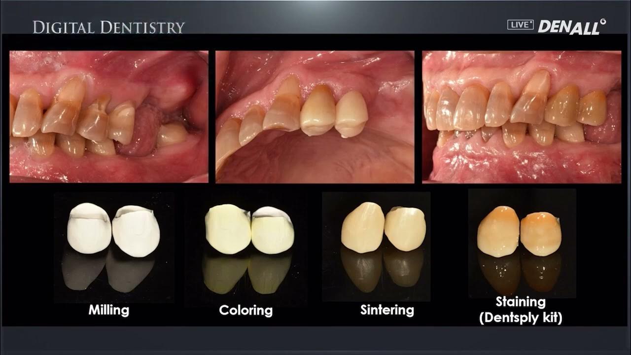 [DIGITAL DENTISTRY] Zirconia Crown Staining (after Sintering) YouTube