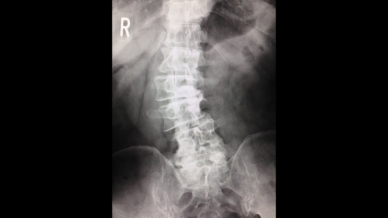 Epidural Catheter Placement by Dr.EpiCal (Scoliosis)2 YouTube