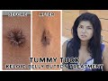 Tummy Tuck can result in keloid belly button! How to treat & before and after pictures