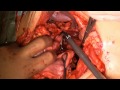 Radical Cystectomy+extPLND