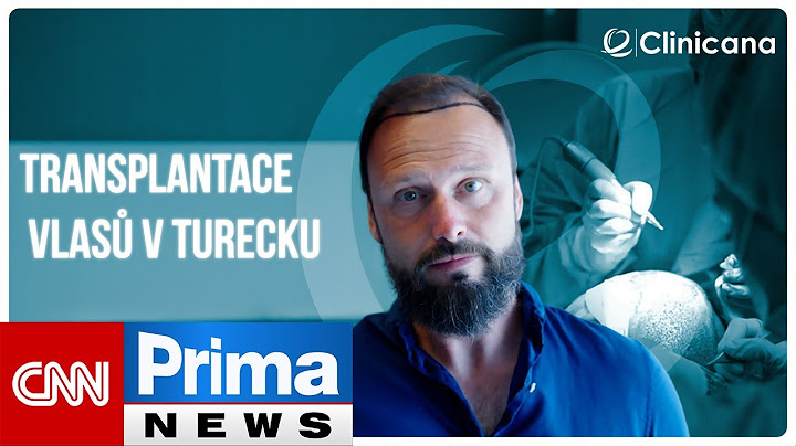 CNN Prima News: Reportáž z transplantace vlasů v Istanbulu | Clinicana