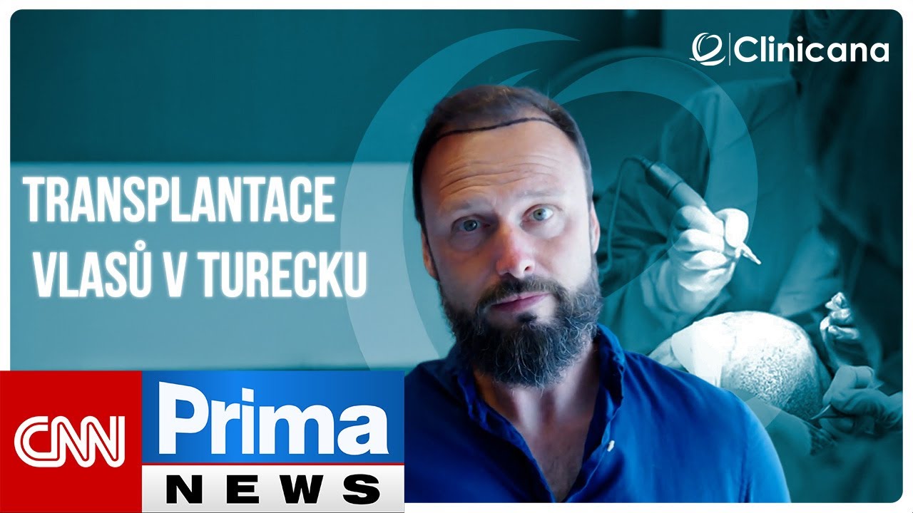 CNN Prima News: Reportáž z transplantace vlasů v Istanbulu | Clinicana
