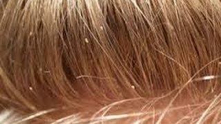 How To Get Rid Of Lice Quickly and permentantly