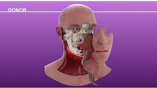 Cameron Underwood Face Transplant Surgical Animation 2018