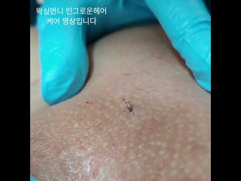 [waxing] 살 속에서 털이 자라요 ◎ 인그로운케어 영상 놓치지마세요☺ #남자브라질리언왁싱