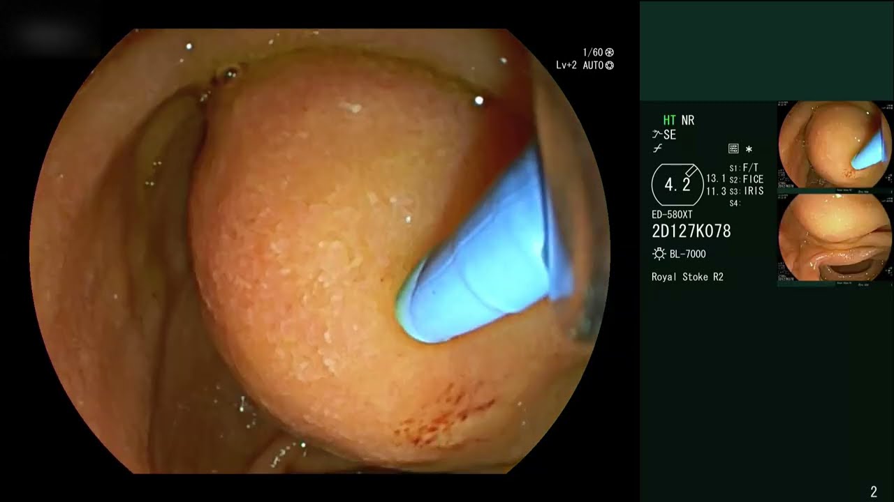 Needle Knife - Trainee & Trainer