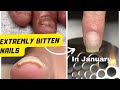 Extremly bitten nails story | she was biting her nails for 50 years | bitten nails transformation