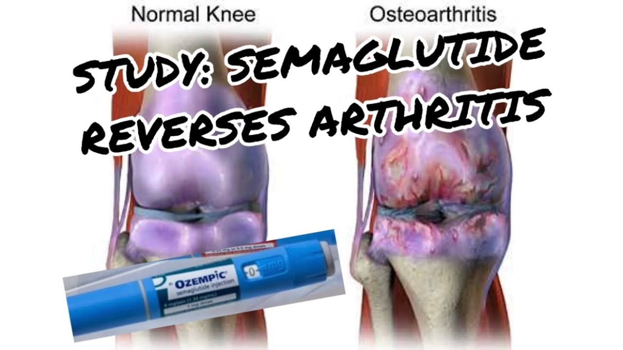 can semaglutide cause sleeplessness Does Semaglutide Make You Tired? Here's What to Do