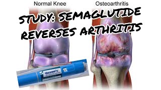 Semaglutide Reverses Arthritis? What the New Study Really Shows