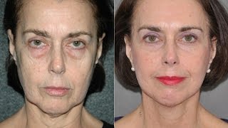 Beverly Hills Mini Facelift Smart Deep Plane Face Neck Lift With Lower Lid Fat Transposition