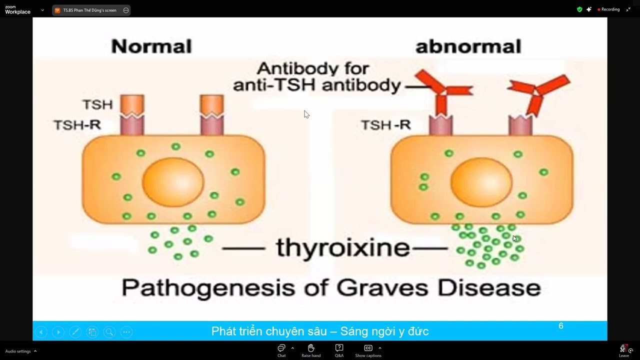Cập nhật chẩn đoán và điều trị bệnh Basedow 28/03/2025