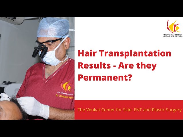 Hair transplant results - Are they permanent? How long does the hair grow?