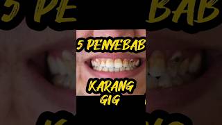 5 Penyebab Karang Gigi