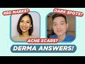 How to treat ACNE SCARS & ACNE MARKS? Dermatologist Answers! (Filipino) | Jan Angelo