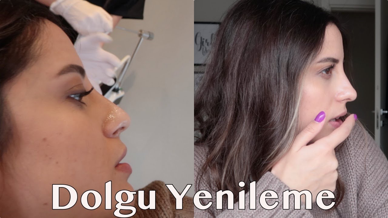 BURUN DOLGUSU GÜNCELLEME !