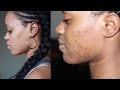 How I cleared my skin | From Severe Acne to Clear Skin
