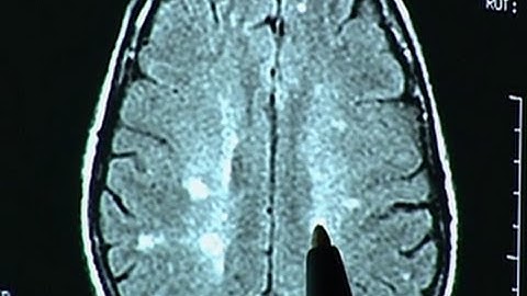 Vitamin D may help early multiple sclerosis