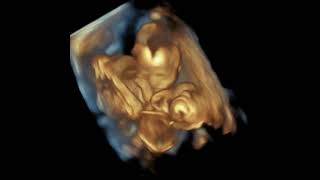 3D Ultrasound Of Twins At 25 Weeks 3 Days Pregnant