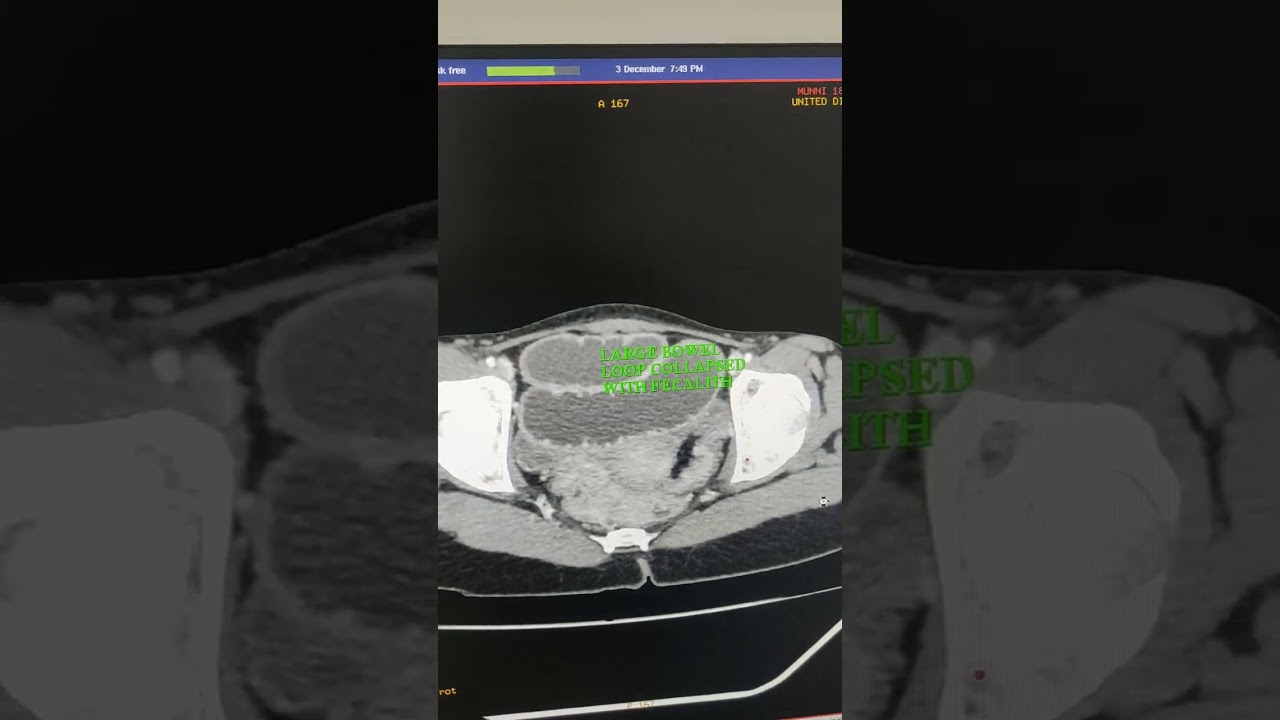 stricture in ileum stomach and duodenum junction are collepsed and collepsed of large bowel loops