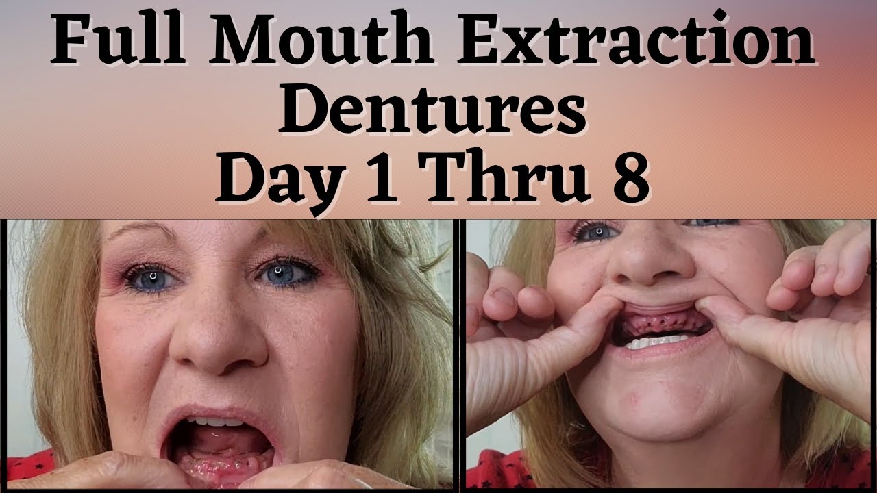 Full Mouth Extraction Immediate Dentures Pictures  