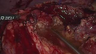 LAPAROSCOPIC STAGE 2 OF ASSOCIATING LIVER PARTITION WITH PORTAL VEIN LIGATION FOR STAGED HEPATECTOMY